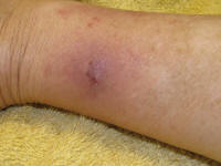 Spider bite, 04/29/10
